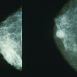 Massa Lubrense, carcinoma alla mammella: prevenzione, diagnosi e cura
